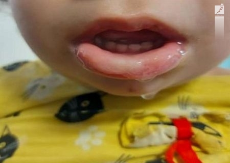 افزایش شیوع مسمومیت با چنته در کودکان هرمزگانی